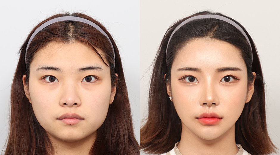 แพ็คเกจศัลยกรรมเกาหลี ดูแลครบจบในทริปเดียว